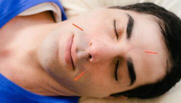 What Is Cosmetic Acupuncture?